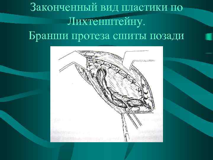 Законченный вид пластики по Лихтенштейну. Бранши протеза сшиты позади семенного канатика 