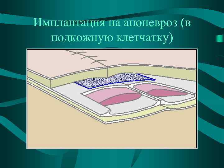 Имплантация на апоневроз (в подкожную клетчатку) 