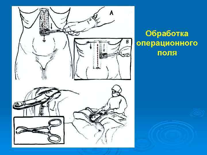 Обработка операционного поля 