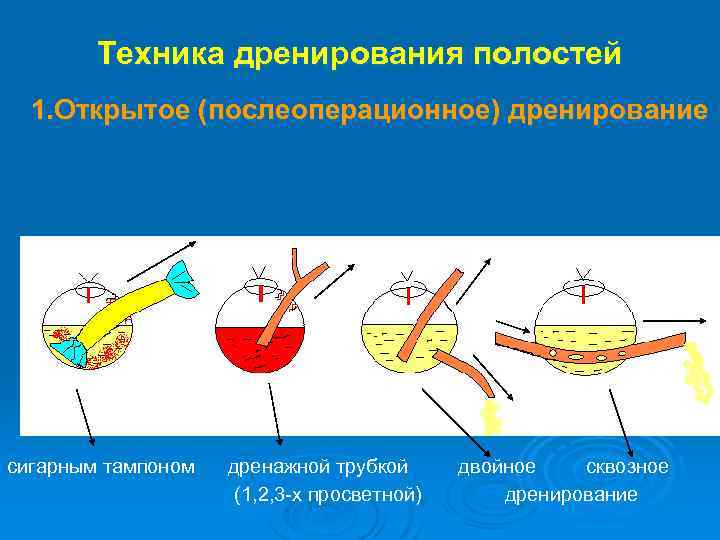 Техника дренирования полостей 1. Открытое (послеоперационное) дренирование сигарным тампоном дренажной трубкой (1, 2, 3