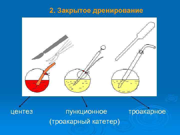 2. Закрытое дренирование центез пункционное (троакарный катетер) троакарное 