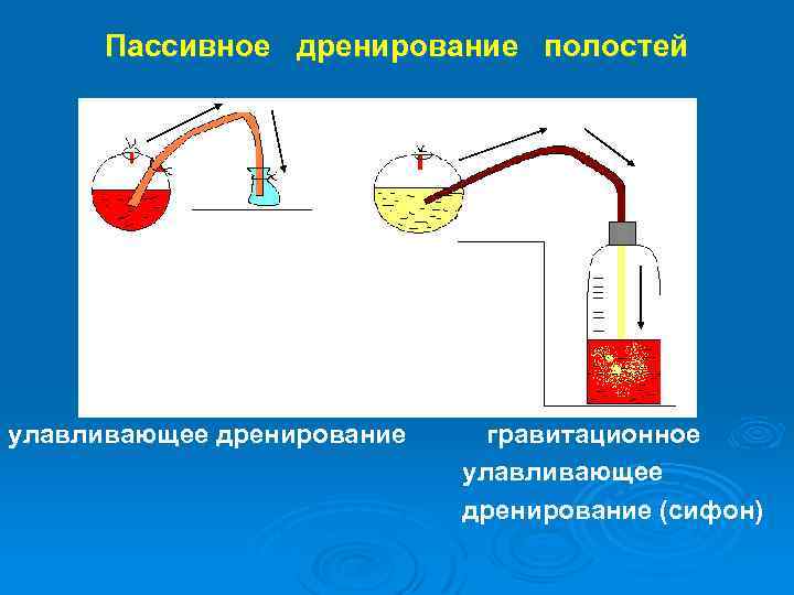 Пассивное дренирование фото