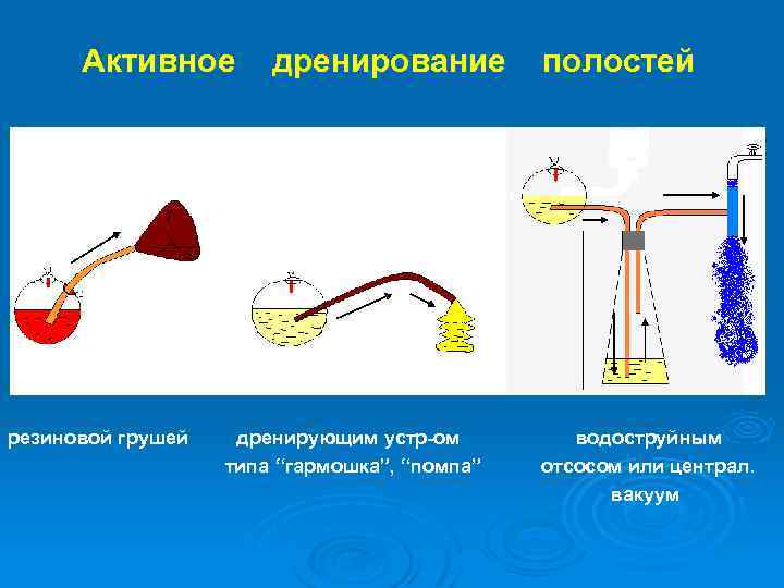 Активное резиновой грушей дренирование дренирующим устр-ом типа “гармошка”, “помпа” полостей водоструйным отсосом или централ.