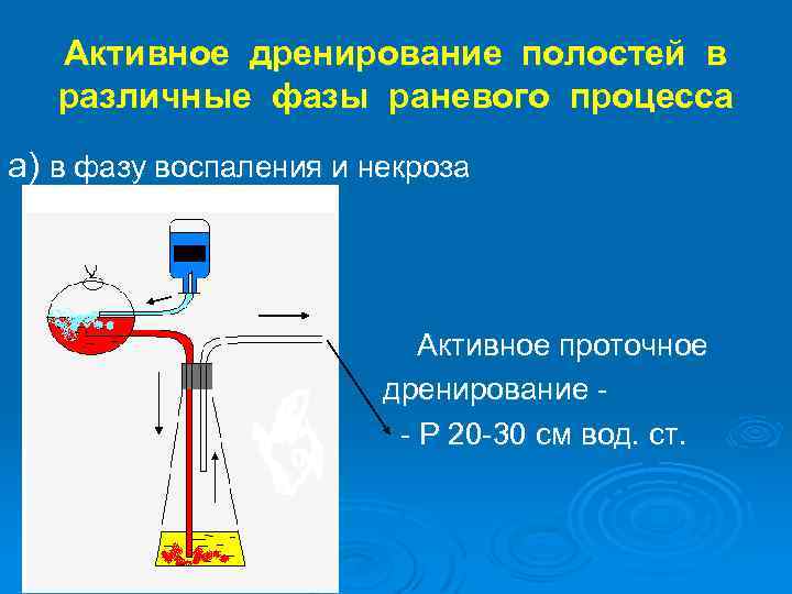 Активное дренирование полостей в различные фазы раневого процесса а) в фазу воспаления и некроза