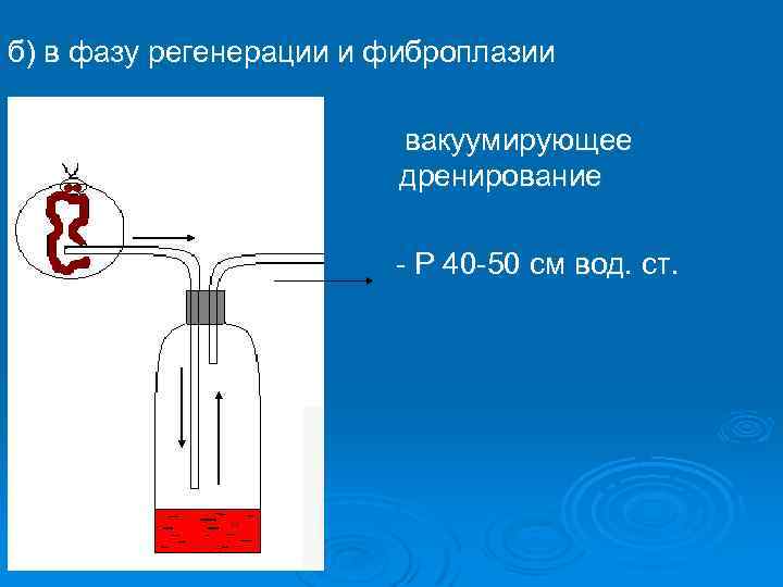б) в фазу регенерации и фиброплазии вакуумирующее дренирование - Р 40 -50 см вод.