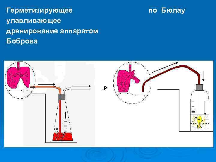Герметизирующее улавливающее дренирование аппаратом Боброва по Бюлау -Р 