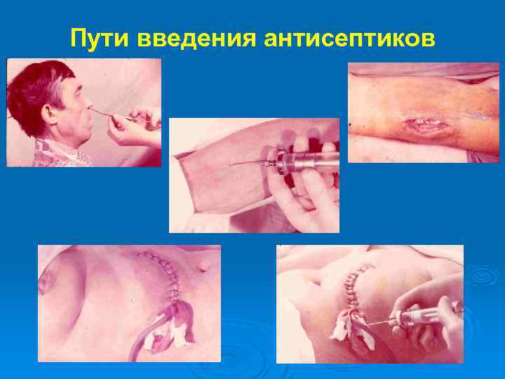 Пути введения антисептиков 