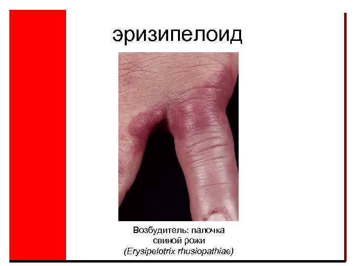 эризипелоид Возбудитель: палочка свиной рожи (Erysipelotrix rhusiopathiae) 