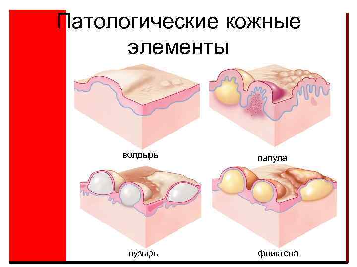 Патологические кожные элементы волдырь пузырь папула фликтена 