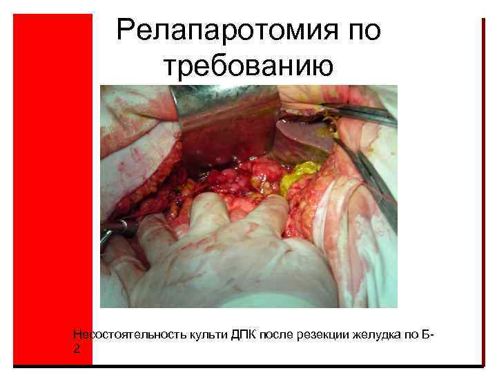 Релапаротомия по требованию Несостоятельность культи ДПК после резекции желудка по Б 2 