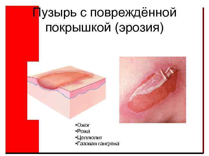 Пузырь с повреждённой покрышкой (эрозия) • Ожог • Рожа • Целлюлит • Газовая гангрена