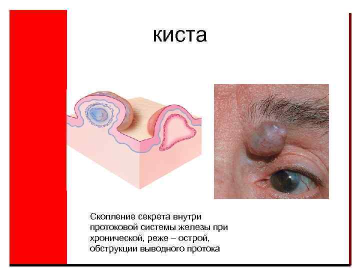 киста Скопление секрета внутри протоковой системы железы при хронической, реже – острой, обструкции выводного