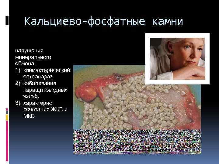 Кальциево-фосфатные камни нарушения минерального обмена: 1) климактерический остеопороз 2) заболевания паращитовидных желёз 3) характерно