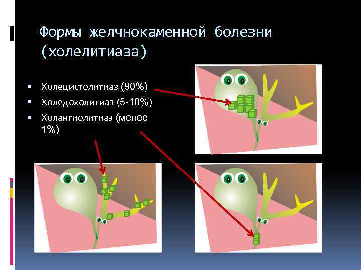 Формы желчнокаменной болезни (холелитиаза) Холецистолитиаз (90%) Холедохолитиаз (5 -10%) Холангиолитиаз (менее 1%) 