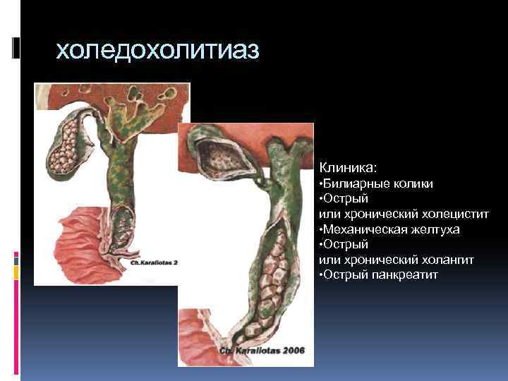 холедохолитиаз Клиника: • Билиарные колики • Острый или хронический холецистит • Механическая желтуха •