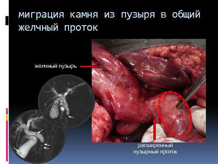 миграция камня из пузыря в общий желчный проток желчный пузырь расширенный пузырный проток 
