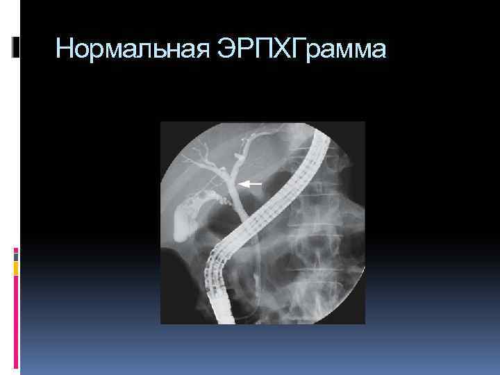 Нормальная ЭРПХГрамма 