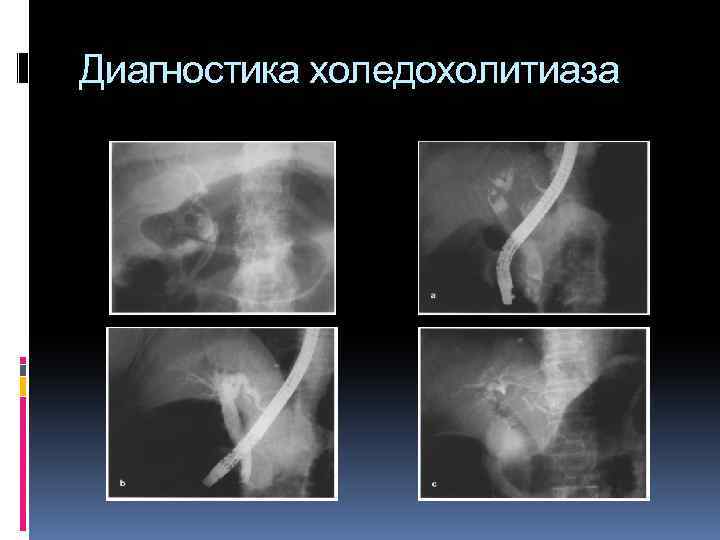 Диагностика холедохолитиаза 