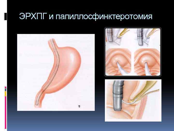 ЭРХПГ и папиллосфинктеротомия 