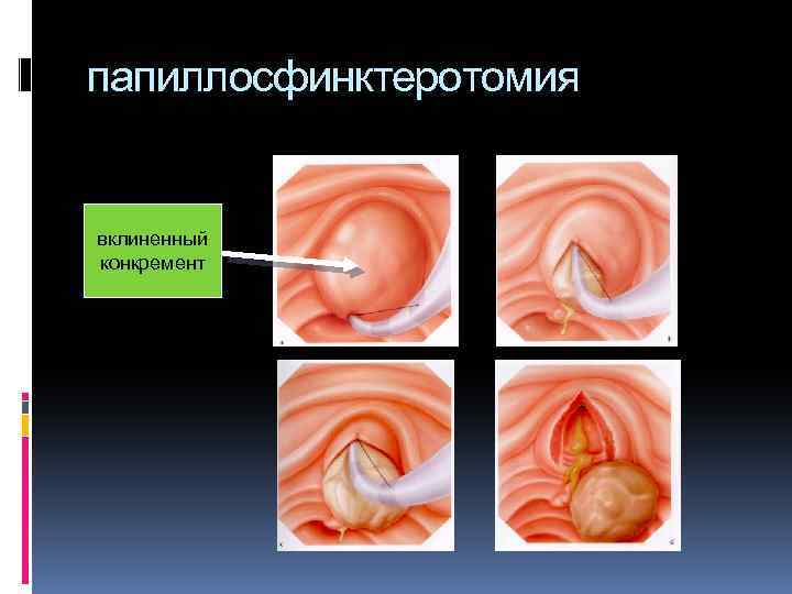 папиллосфинктеротомия вклиненный конкремент 