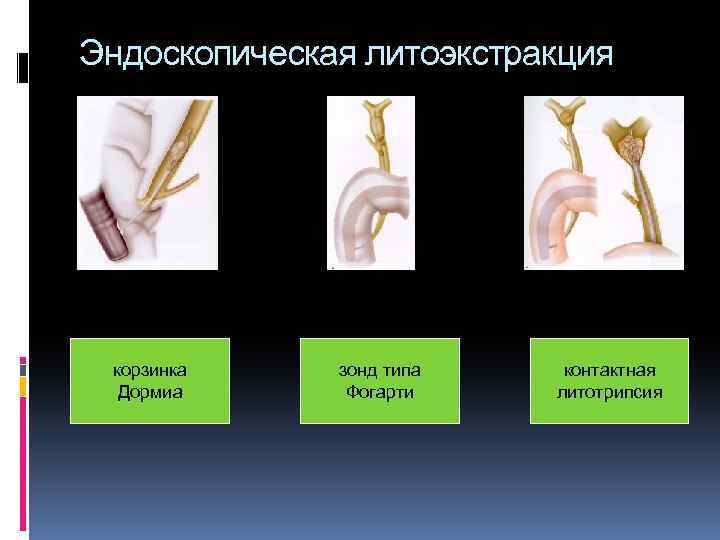 Эндоскопическая литоэкстракция корзинка Дормиа зонд типа Фогарти контактная литотрипсия 