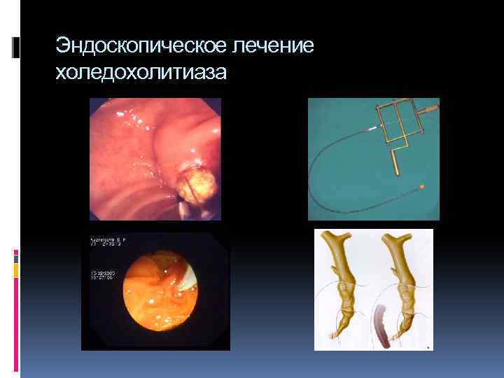 Эндоскопическое лечение холедохолитиаза 