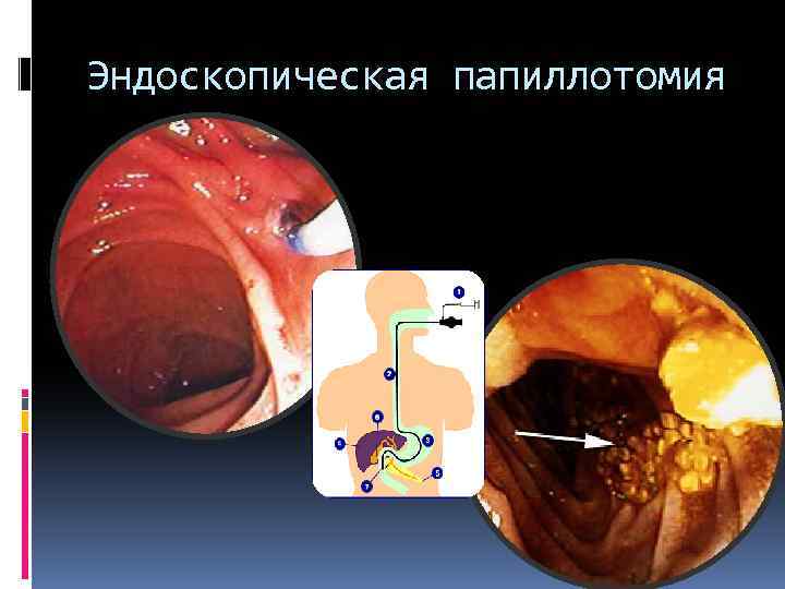 Эндоскопическая папиллотомия 