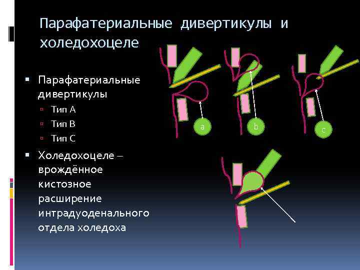 Парафатериальные дивертикулы и холедохоцеле Парафатериальные дивертикулы Тип А Тип В Тип С Холедохоцеле –