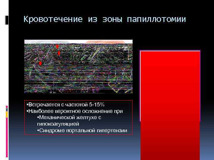 Кровотечение из зоны папиллотомии • Встречается с частотой 5 -15% • Наиболее вероятное осложнение