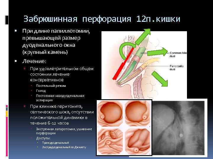 Забрюшинная перфорация 12 п. кишки При длине папиллотомии, превышающей размер дуоденального окна (крупный камень)