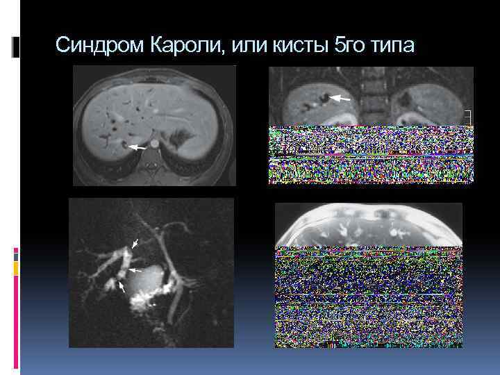Синдром Кароли, или кисты 5 го типа 