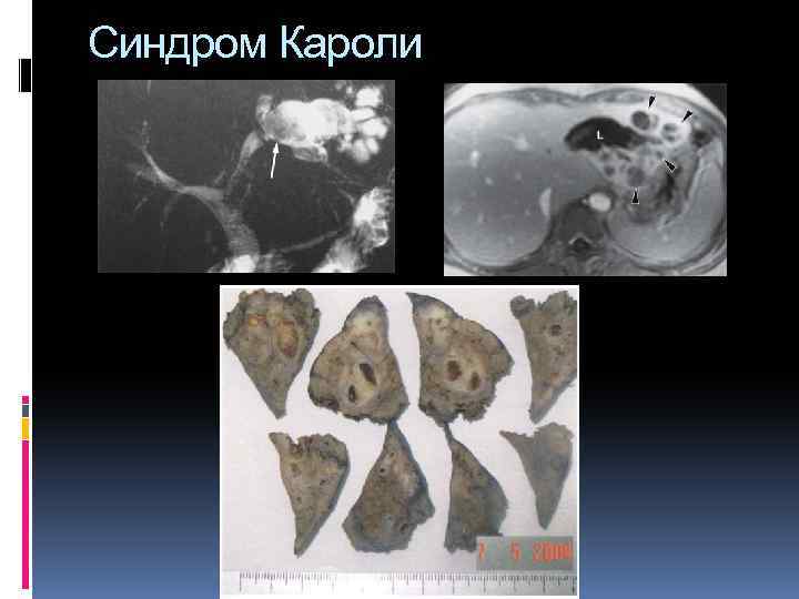 Синдром Кароли 