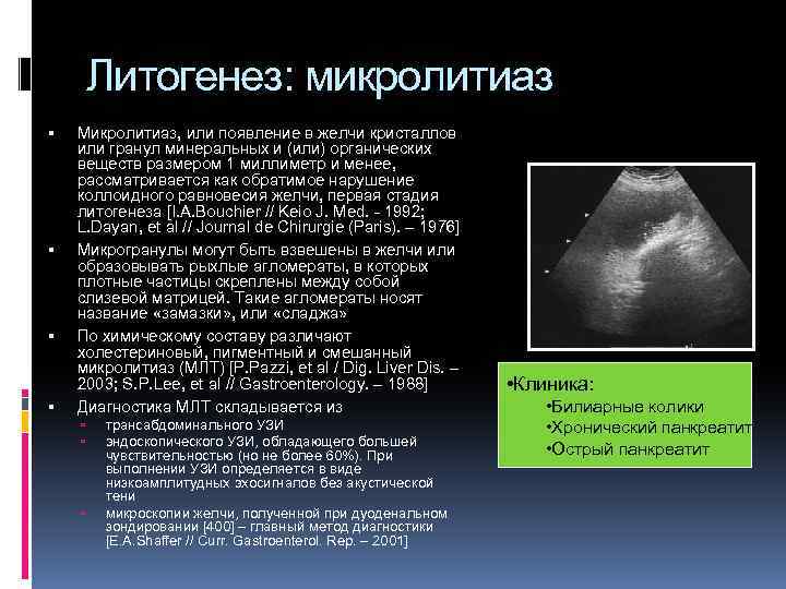 Литогенез: микролитиаз Микролитиаз, или появление в желчи кристаллов или гранул минеральных и (или) органических