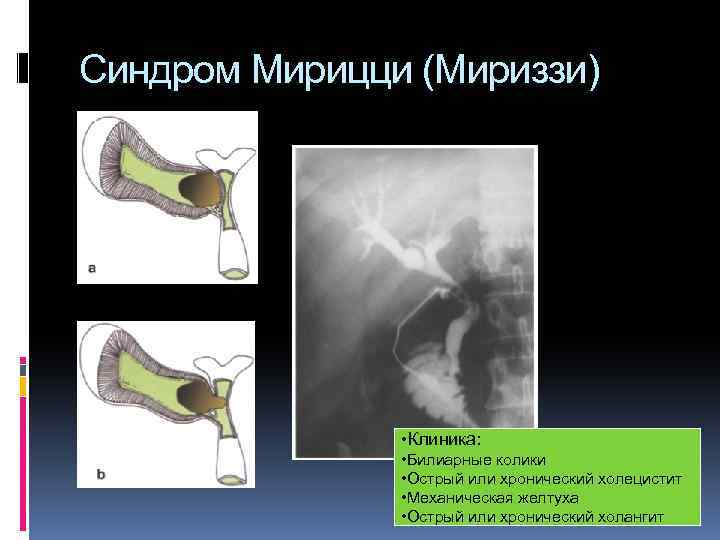 Синдром Мирицци (Мириззи) • Клиника: • Билиарные колики • Острый или хронический холецистит •
