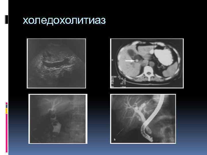 холедохолитиаз 
