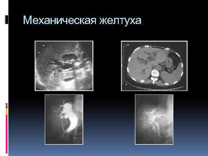 Механическая желтуха 