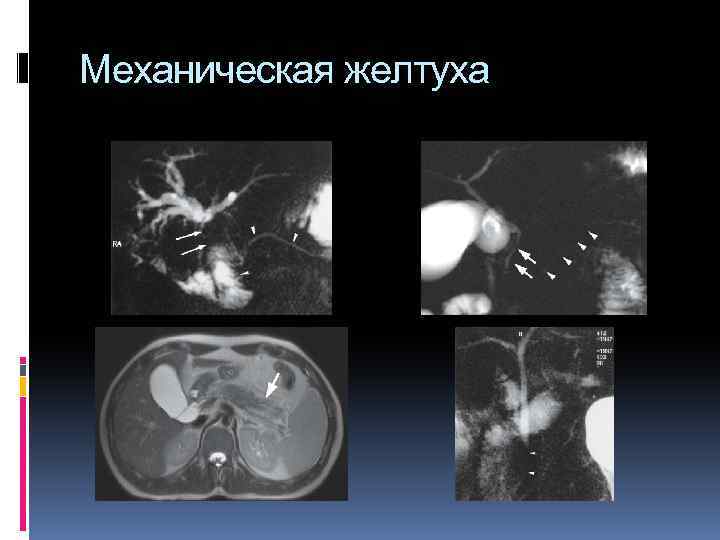 Механическая желтуха 