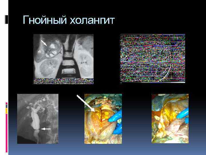 Гнойный холангит 