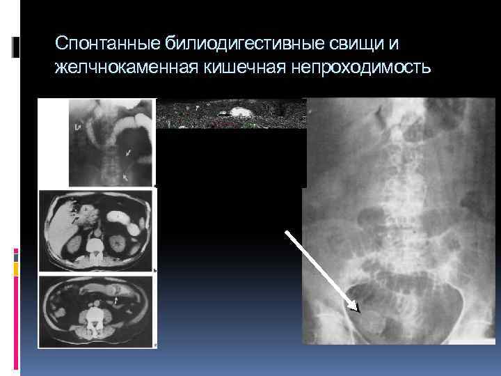 Спонтанные билиодигестивные свищи и желчнокаменная кишечная непроходимость 