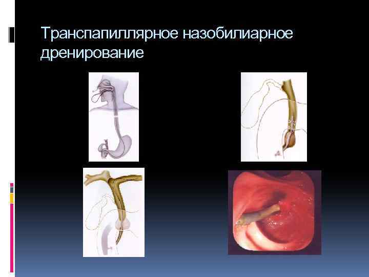 Транспапиллярное назобилиарное дренирование 