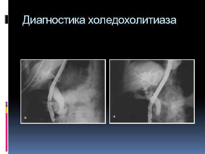 Диагностика холедохолитиаза 