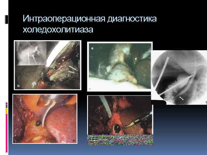 Интраоперационная диагностика холедохолитиаза 