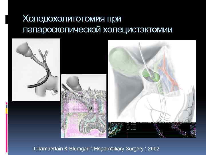 Холедохолитотомия при лапароскопической холецистэктомии Chamberlain & Blumgart  Hepatobiliary Surgery  2002 