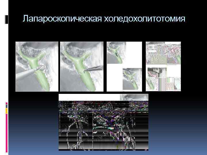 Лапароскопическая холедохолитотомия 