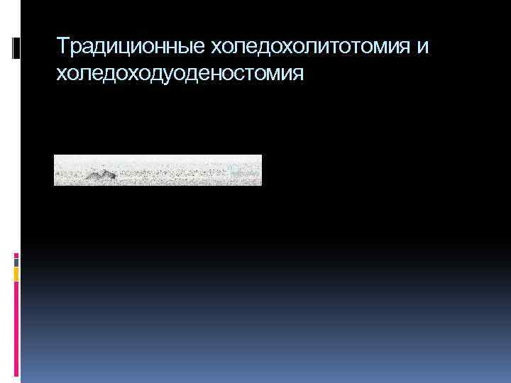 Традиционные холедохолитотомия и холедоходуоденостомия 