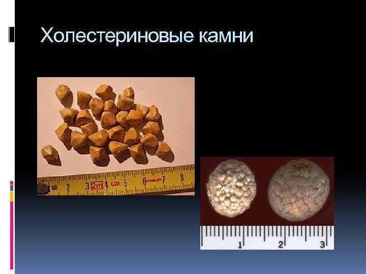 Холестериновые камни 