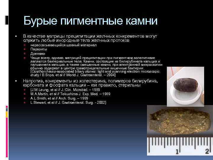 Бурые пигментные камни В качестве матрицы преципитации желчных конкрементов могут служить любые инородные тела