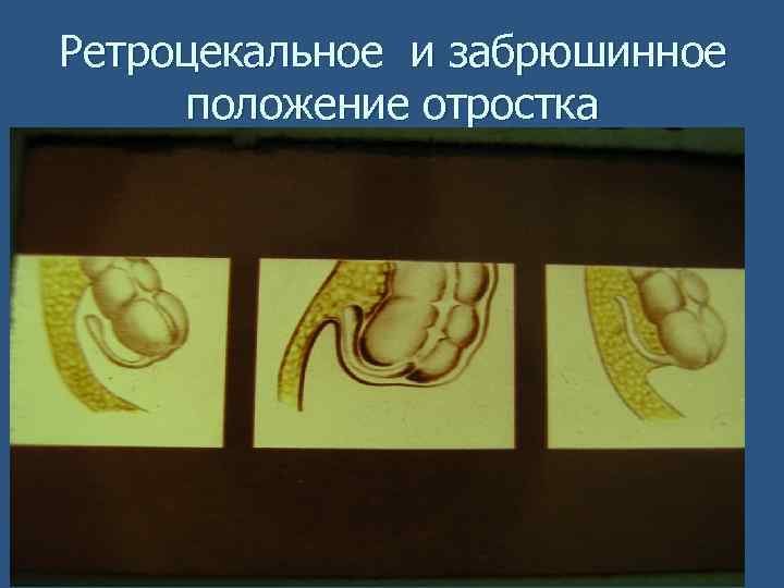 При ретроцекальном расположении червеобразного отростка характеристикой клинической картины является