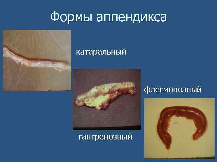 Формы аппендикса n катаральный флегмонозный гангренозный 