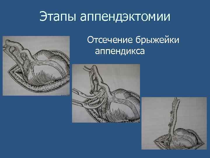 Этапы аппендэктомии Отсечение брыжейки аппендикса 